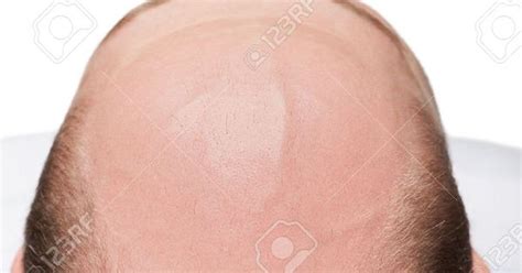 12928872 Human Alopecia Or Hair Loss Adult Man Bald Head Top View Stock
