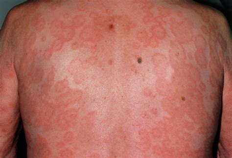 Erythema Multiforme Skin Rash On Back Of Male Photograph By Dr P