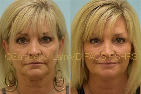 Kybella Dallas Submental Fat Reduction Plano Tx