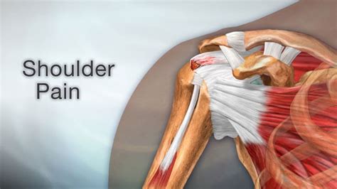 Shoulder Pain Anatomy Map Shoulder Blade Pain Potential Causes