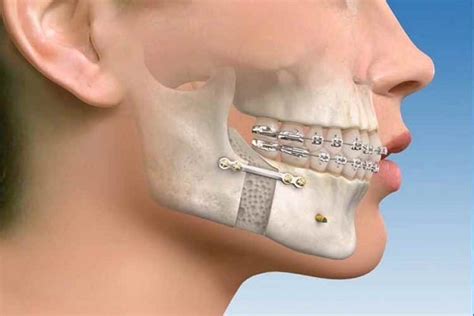 Fracture Of Jaw Treatment Drearles Diamond Dental