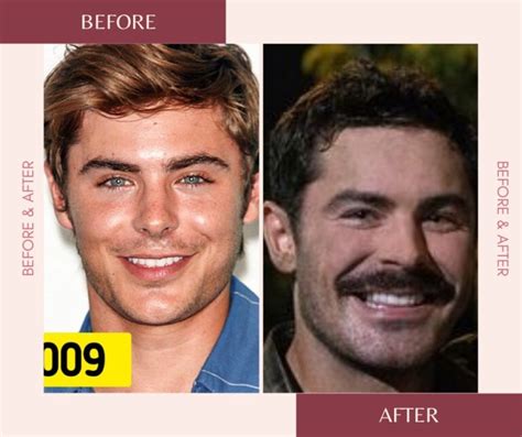 Zac Efron’s Incredible Transformation All You Need To Know About His Plastic Surgeries