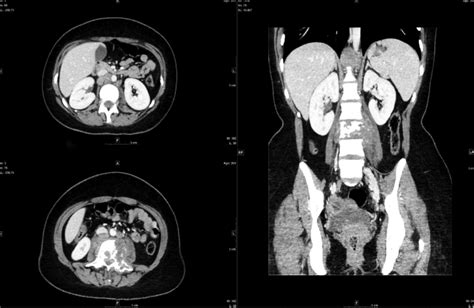 Ct Scan Large Retroperitoneal Lymph Nodes Are Seen In The Paraaortic
