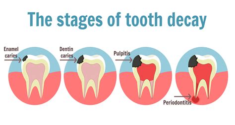 Root Canal Mandurah Halls Head Dentists Comfy Dental