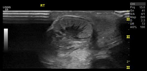 Neonatal Testicular Torsion Image