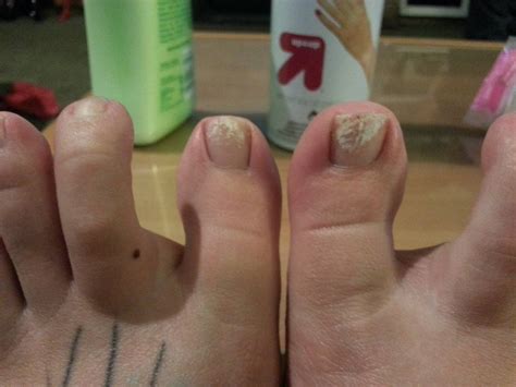 Took Off My Toenail Polish And Now Have Weird White Marks Only Where The Polish Was It S Not