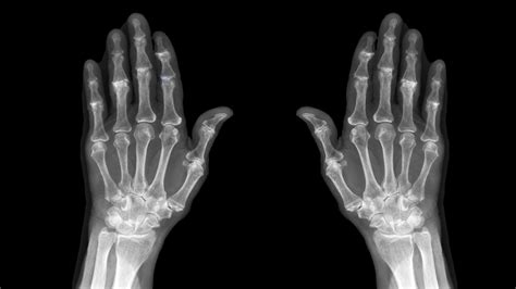 Osteoarthritis Hand Xray