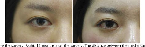 Epicanthic Fold Surgery Before And After