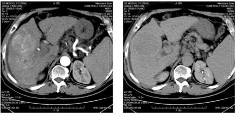 Triphasic Ct Scan Of The Liver Shows Multifocal Hcc Of The Right Liver