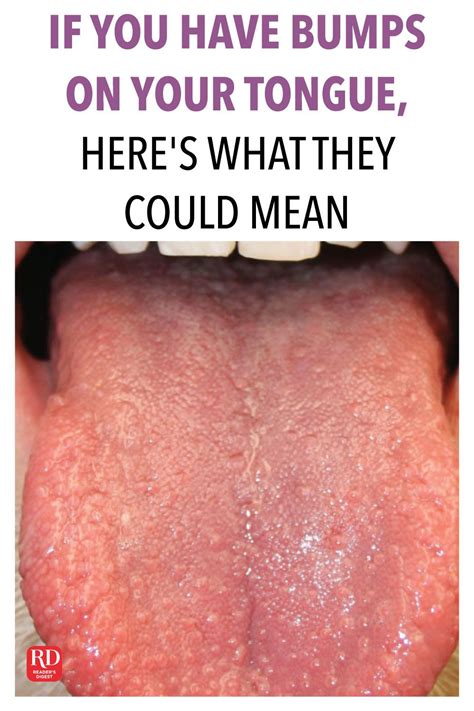 Sore Throat Bumps On Tongue