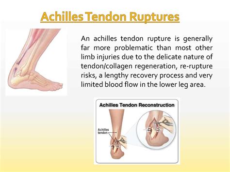 Pain of the achilles tendon commonly affects both competitive and recreational athletes as well as the sedentary patient. Calaméo - Treatment of Achilles Tendon Ruptures