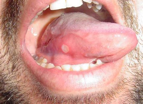 Canker Sore Overview Causes Diagnosis And Pictures Canker Sore