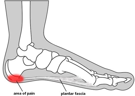 Plantar Fasciitis And Heel Pain Treatments Hss Foot And Ankle