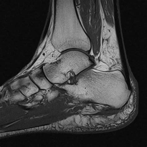 These results suggest that magnetic resonance imaging measures may be useful in understanding the etiology and rehabilitation of chronic plantar fasciitis. Irene Porcaro What Is Painful Heel And How You Can Remedy It