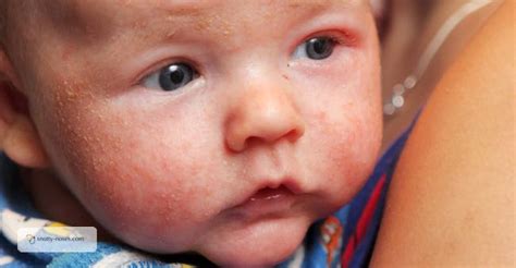 Eczema In Babies Toddlers And Children Snotty Noses