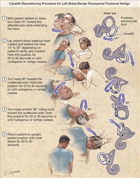 Treat Benign Paroxysmal Positional Vertigo With The Epley Maneuver