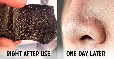 Blackhead Strips Before And After Queasy Gamer