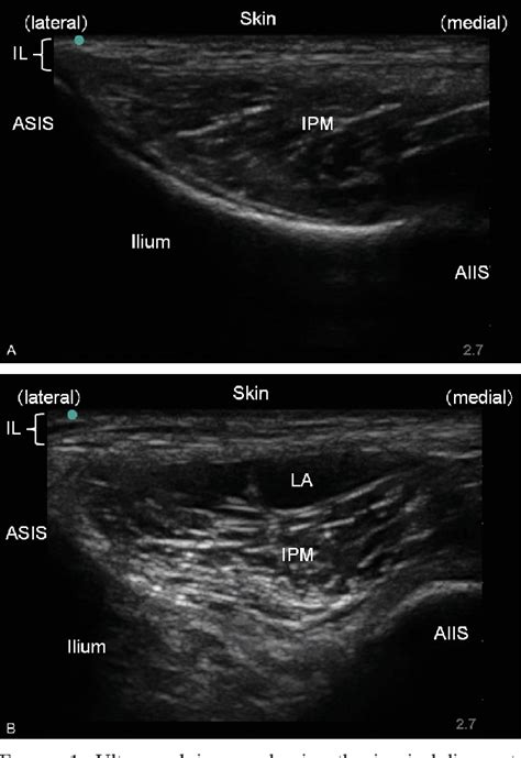 Ultrasound Guided Lateral Femoral Cutaneous Nerve Block Comparison Of