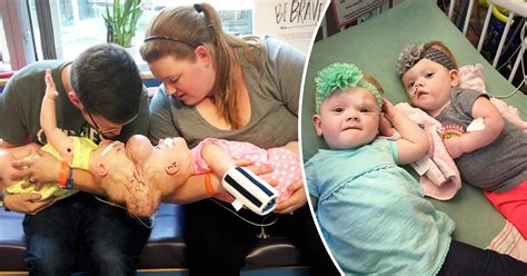 Twins Conjoined At Head Survived Separation Are Now 4 Thriving