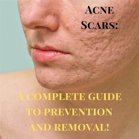 How To Get Rid Of Acne Scars Luminositie