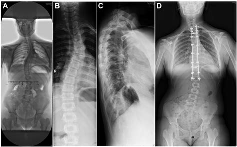 X Ray Photographs Of The Thorax Of The Patient A Severe Scoliosis B