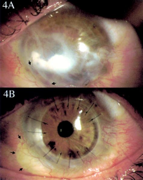 A New Classification Of Ocular Surface Burns British Journal Of