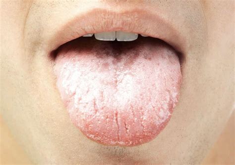 White Spots On Tonsils What Are White Spots On Tonsils