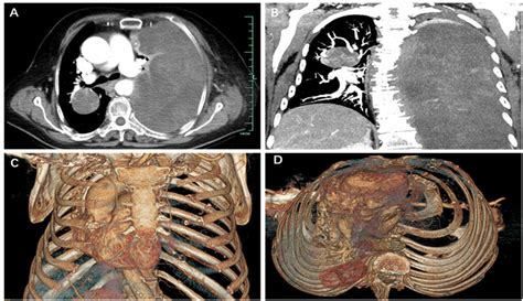 A Case Study Of A Large And Rare Pleomorphic Liposarcoma In The Chest Area
