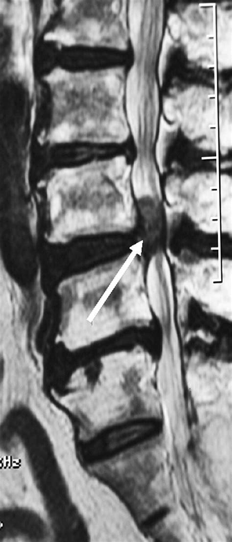 Intradural Lumbar Disc HerniationIs It Predictable Preoperatively A Report Of Two Cases The