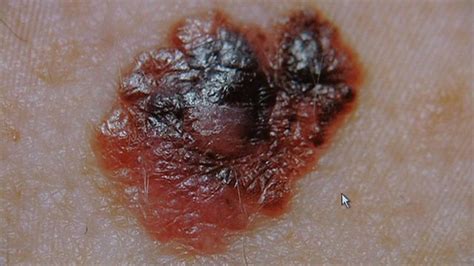 Bbc News Tayside A Skin Cancer Hot Spot