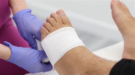 Tailors Bunion Surgery Recovery Time 5 Powerful Tips