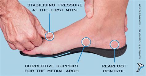 How To Prevent Postsurgical Hallux Valgus Recurrences Mass4d® Foot