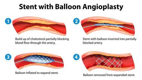 Coronary Artery Stenting Houston Cardiovascular Institute