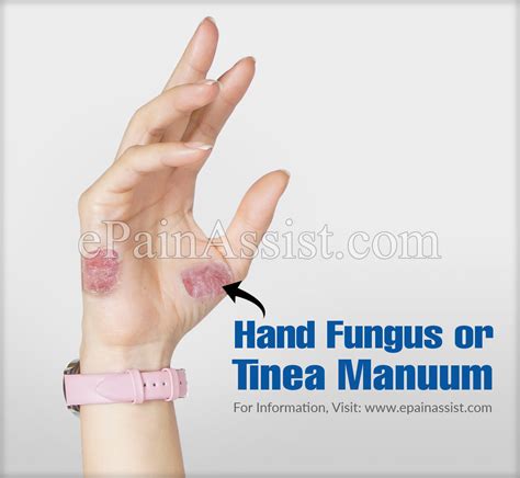 Hand Fungus Or Tinea Manuumcausessymptomstreatmentpreventiondiagnosis