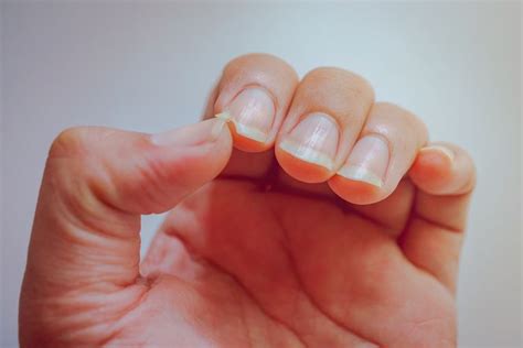 Ridges In Fingernails Causes And Treatments