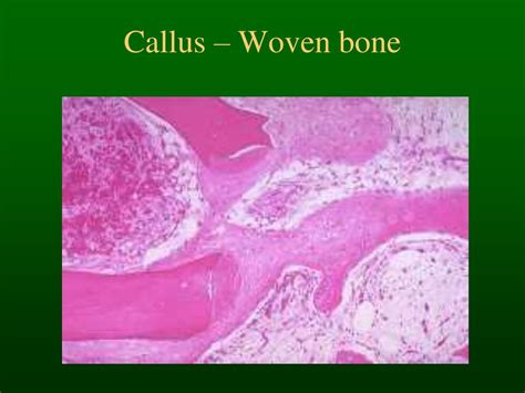 Ppt Bone Histology And Fracture Healing Powerpoint Presentation Id