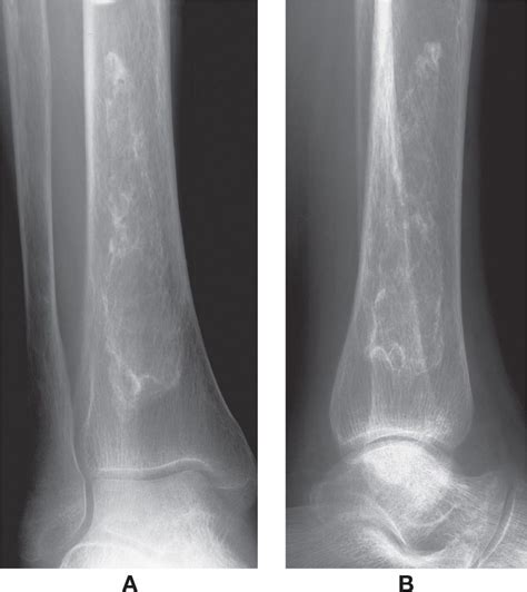 17 Osteonecrosis And Osteochondrosis Musculoskeletal Key