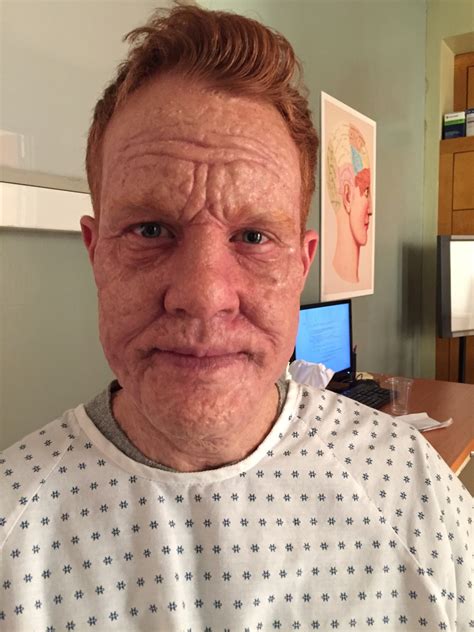 When dioxins enter the food chain, humans retain substances of it in their fatty tissue. Scream Queens Dioxin Poisoning Makeup - Vincent Van Dyke ...