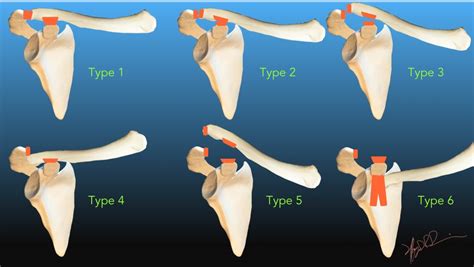 Classification Of Ac Joint Separation Best Shoulder Doctor In India