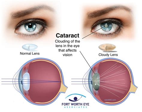 cataract surgery procedure safety recovery and effects