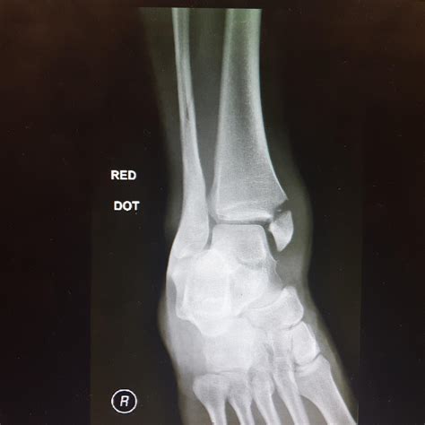 Xray Of Broken Ankle