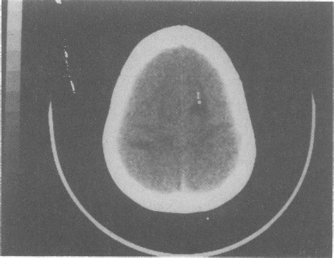 Computed Tomographic Scan Of The Brain Showing A Definite Low