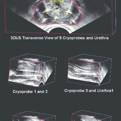 Verifying With 3 Dimensional Ultrasonography 3dus Cryoprobes