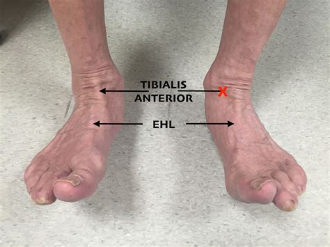 Compensating For Loss Running On One Tibialis Anterior Bmj Case Reports