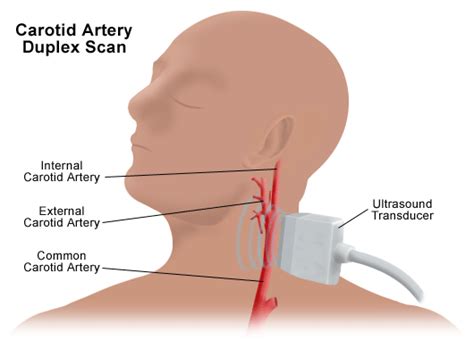 The middle meningeal artery (a. Ultrasound of the neck - how to make diagnosis ...