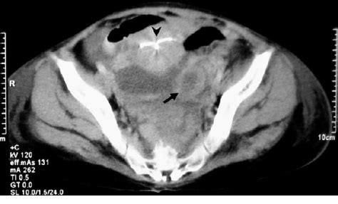 abdominal computer tomography reveals formation of abscess arrow and download scientific