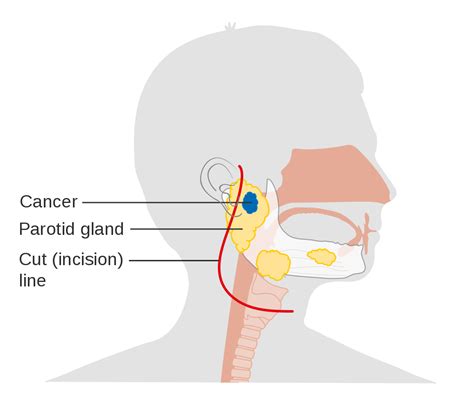 Parotid Gland Tumor Symptoms