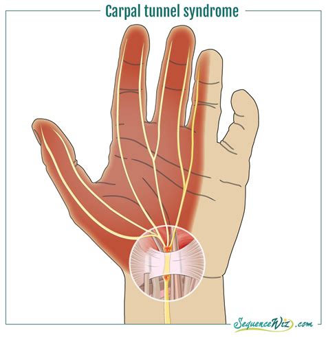 If you or a loved one suffers from tendonitis or carpal tunnel syndrome pain please schedule a telemedicine consultation to learn about the best treatment options and for an accurate diagnosis of wrist. Why do we get wrist pain? - Sequence Wiz