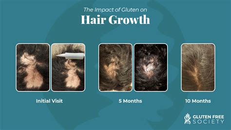 Can Gluten Cause Hair Loss Gluten Free Society