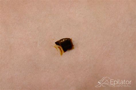 It a traditional drawing salve that soothes the skin. Homemade Drawing Salve For Cysts - Homemade Ftempo